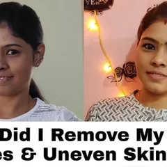 Here you can see how I tackled two common problems at once: dark circles and uneven skin tone. With a dedicated routine using gentle, natural remedies, I was able to lighten the area under my eyes and achieve a more balanced, glowing complexion.
