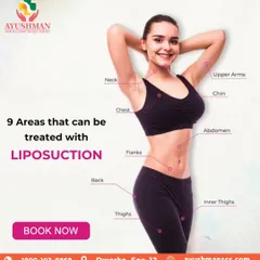 Liposuction is a precise surgical body sculpting tool that can target stubborn fat in up to nine different areas. This visual guide shows the versatility of the procedure, from the abdomen and thighs to the back and upper arms, helping you achieve a comprehensively contoured physique.