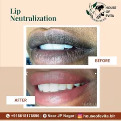 A fantastic result from a Lip Neutralization treatment. The client's lips are visibly brighter and have a uniform color, enhancing her beautiful smile.