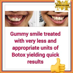 A "gummy smile" can be easily and effectively treated with a few units of Botox. This before and after shows how the treatment relaxes the upper lip muscle, allowing for a beautiful smile that reveals less gum.