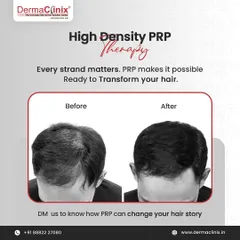This before-and-after photo shows the transformative power of High-Density PRP. It can take hair from thinning to thriving by boosting natural growth and density.