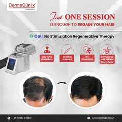 Imagine regaining your hair in just one session. Our GCell Bio Stimulation Regenerative Therapy is a one-time, minimally invasive procedure with no downtime that uses your body's own stem cells to reactivate hair follicles.