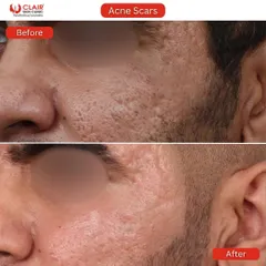 This client's deep-set acne scars have been visibly softened and reduced. Our treatments focus on rebuilding collagen beneath the scars to lift them from within, resulting in a much smoother skin surface.