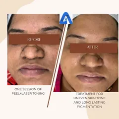 A frontal view showing the significant reduction in facial pigmentation and improved skin brightness after a single session of a peel and laser toning. The treatment helps address sun damage and post-acne marks effectively.
