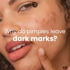 Many patients ask why pimples leave dark marks. This is the start of a series explaining post-inflammatory hyperpigmentation and how to manage it.