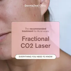Acne scars don't have to be a permanent concern. My Fractional CO2 Laser treatment is a recommended, advanced solution that works deep within the skin to stimulate collagen and smooth out texture for a clearer complexion.