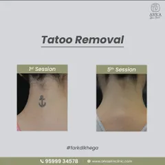 A clear before-and-after comparison of a neck tattoo. This shows the significant fading achieved after just five sessions of our laser treatment.