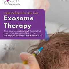 Here you can see the application of Exosome Therapy, one of the latest non-surgical solutions I offer for hair loss. This treatment uses growth factors to stimulate hair follicles and improve the overall health of your scalp, promoting natural regrowth.