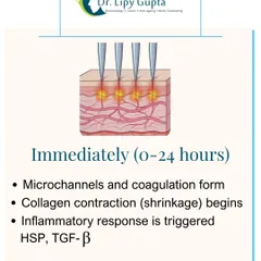 Within the first 24 hours, collagen contraction begins, starting the skin tightening process.