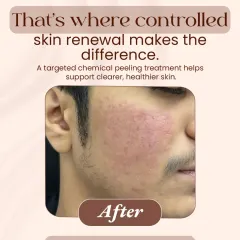 Here is the same patient's skin after just two sessions of a controlled, targeted chemical peel. The treatment has visibly calmed the active breakouts, reduced redness, and initiated a healthier skin renewal process, leading to a much clearer complexion.