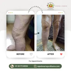 This image documents the healing journey for a client with a severe skin condition on their leg. The 'after' photo shows a dramatic reduction in scaling and inflammation, demonstrating the effectiveness of long term Ayurvedic care.