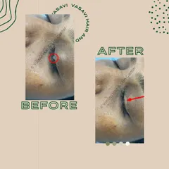Removing a wart from the delicate skin near the eye, as seen here, requires a gentle and precise approach. I use specialized techniques to safely eliminate the growth without compromising the sensitive surrounding tissue.