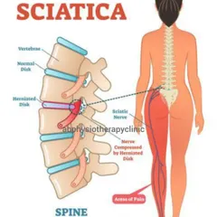 This diagram clearly illustrates how a herniated disc can compress the sciatic nerve, leading to pain that radiates down the leg. Our treatments aim to decompress the nerve and resolve the inflammation.