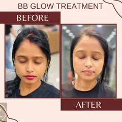 Experience the immediate radiance of a BB Glow treatment. This client's skin looks visibly brighter, more even-toned, and refreshed right after the procedure. It's a fantastic non-invasive option for long-lasting complexion enhancement.