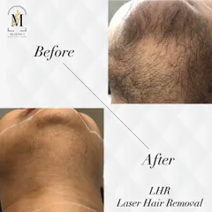 This image showcases the results of laser hair removal for a male client's beard line and neck. The treatment provides a clean, well-defined look and helps prevent razor bumps.