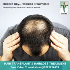 This image shows a common pattern of hair loss known as crown balding. We offer modern hair loss treatments, from non surgical therapies to advanced hair transplants, to effectively address this and restore density to the crown area.