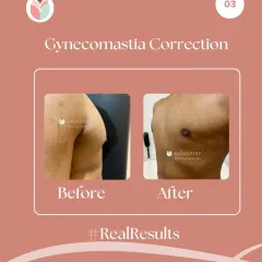 This before and after result shows the significant improvement possible with gynecomastia surgery. The procedure flattens the chest by removing both fat and glandular tissue, leading to a major boost in confidence.