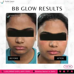 Here is another fantastic result from our BB Glow facial. You can see the improvement in skin texture and the reduction of minor blemishes. The after photo shows a healthy, radiant glow that looks natural and fresh.