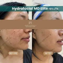 This before-and-after showcases the immediate results of a single Hydrafacial MD Elite session. Notice the visible reduction in pigmentation and uneven texture, and the significant improvement in overall skin clarity and radiance. This is the kind of healthy, hydrated glow you can expect.