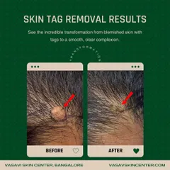 Skin tags can also appear on the scalp, as shown here. I carefully remove these growths to restore a smooth surface without damaging hair follicles, ensuring a clean and unnoticeable result.
