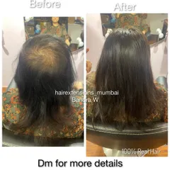 This before and after at our Bandra West studio shows a client with significant thinning at the crown, and the after shows complete coverage with our 100% real hair topper.