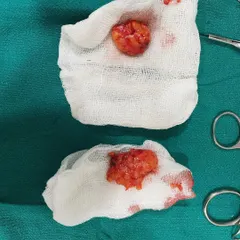 Here are the buccal fat pads after they have been excised. Removing this specific pocket of fat from the cheeks results in a more defined and less "chubby" facial appearance.