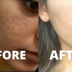 For this patient, I designed a CO2 laser treatment plan to address persistent acne scarring. The 'after' photo shows a dramatic improvement in skin smoothness and a reduction in the depth of the scars.