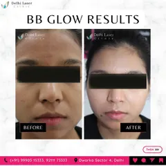 The results of our BB Glow treatment speak for themselves. This client's skin tone is visibly more even, with reduced patchiness and a brighter complexion after the session. It provides a flawless base without the need for daily foundation.
