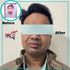 This client came to us seeking a solution for frontal hair loss. The after photo shows a successful hair restoration, creating a natural and fuller look that frames his face perfectly.