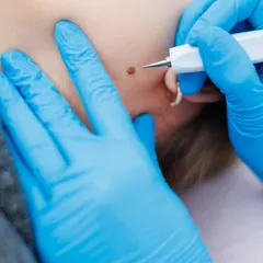 A close-up view of a mole removal procedure on the face. Using specialized tools, I ensure the removal is precise and cosmetically elegant, which is especially important for visible areas like the face and neck.