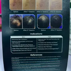 These before-and-after images show the results you can expect from Exosome therapy for both skin and hair. Notice the visible reduction in pigmentation and improvement in skin texture, alongside increased hair density and coverage for hair loss patients.