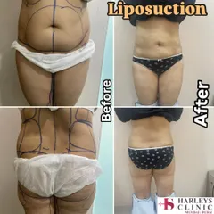 A comprehensive liposuction result for the abdomen and back. The pre-operative markings show the areas I targeted to remove localized fat deposits. The after photo displays a significantly improved body shape and proportion, highlighting how body sculpting can address areas resistant to diet and exercise.