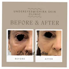 Here is another example of under-eye correction. By carefully placing filler in the tear trough, I can smooth the transition between the cheek and the under-eye, resulting in a younger, fresher look.