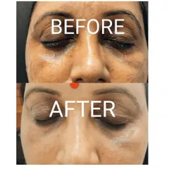 A powerful before-and-after comparison of our Dermafrac treatment for the under-eye area. Notice the visible improvement in skin texture, reduction in fine lines, and lightening of dark pigmentation, demonstrating the rejuvenating power of this therapy.