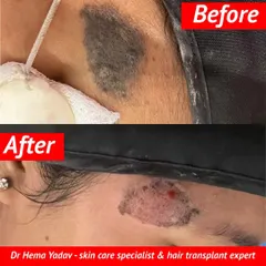 This before-and-after image shows the removal of a hairy nevus, a type of birthmark. Treating deeper or more complex lesions like this requires a careful, expert approach to ensure the best possible cosmetic outcome. I assess each case to determine the most suitable removal method.