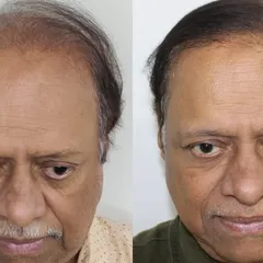 A frontal view showcasing the complete transformation. This result demonstrates that it's never too late to invest in your confidence.