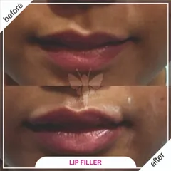 A beautiful, natural-looking lip enhancement using dermal fillers. I focused on adding subtle volume and definition to create a fuller, more hydrated appearance while maintaining the natural shape of the lips.