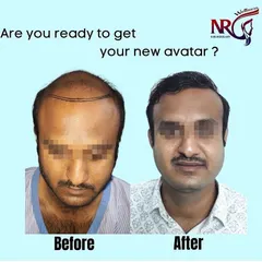 This is the new avatar we help our clients achieve. On the left, you see significant hair loss due to male pattern baldness, and on the right, the final result after our high-density Micro-FUE hair transplant. This transformation took place over 12 months.