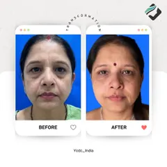 A subtle change can make all the difference. For this patient, I used hyaluronic acid fillers to address under-eye hollows and restore volume to the cheeks. The result is a refreshed, more youthful appearance that looks completely natural, not "done". This is about graceful aging and enhancing your own features.