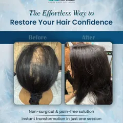 We helped this client combat female pattern hair thinning with a custom hair topper. The 'after' photo shows a significant increase in volume and a seamless blend with her natural hair, achieved in just one painless session.