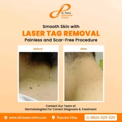 This image shows the result of a laser skin tag removal on the neck. The procedure is painless and scar free, effectively clearing the skin of these common growths.