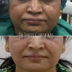 This patient's transformation is a testament to patience and a combination approach. We used a mix of dermal fillers, peels, and facial slimming with Botox over time to achieve this rejuvenated and natural-looking result.