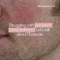 Struggling with persistent facial redness? Let's talk about Rosacea. It often appears as blushing or redness on the cheeks and nose and can sometimes include acne-like bumps.