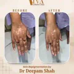 Here is another example of successful skin repigmentation on the hands, an area commonly affected by vitiligo. My treatment plans are designed to be safe and effective, helping patients regain confidence in their skin's appearance.