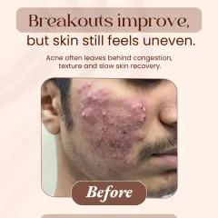 This image shows a patient's skin before treatment, characterized by severe active breakouts, inflammation, and uneven texture. This is the starting point from which we design a targeted, multi-session treatment plan to calm the skin and begin the healing process.