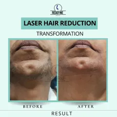 This before and after shows the result of laser hair reduction on the chin area for a male client. The treatment effectively reduces coarse stubble, leading to smoother skin and less shaving irritation.