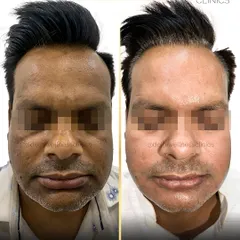 A frontal view of the same client, showing how the treatment evened out his skin tone across the forehead and cheeks, resulting in a brighter, more refreshed look.
