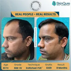 This 33-year-old patient with Norwood Grade 4 hair loss received 3220 grafts. The 8-month result shows a remarkable restoration of the frontal and middle areas, creating a natural and dense appearance that completely changes his look.