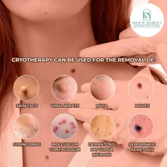 Cryotherapy is a versatile treatment that can be used for the removal of a wide range of skin growths. This includes skin tags, viral warts, milia, moles, syringomas, and other common dermatological concerns.