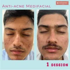 The result of just one session of our anti-acne medifacial. This treatment is designed to deeply cleanse pores, reduce inflammation, and calm active breakouts, setting the foundation for clearer skin.